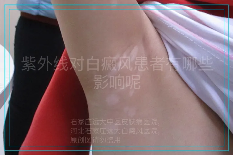 紫外线对白癜风患者有哪些影响呢