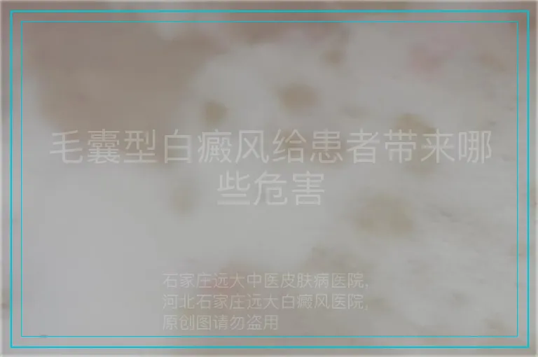 毛囊型白癜风给患者带来哪些危害