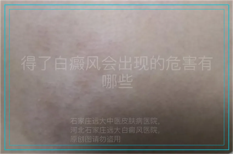得了白癜风会出现的危害有哪些