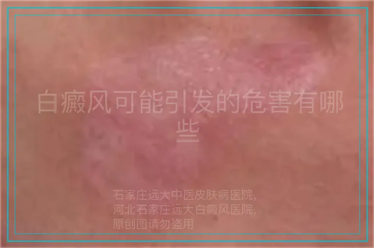 白癜风可能引发的危害有哪些