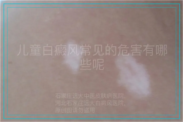 儿童白癜风常见的危害有哪些呢