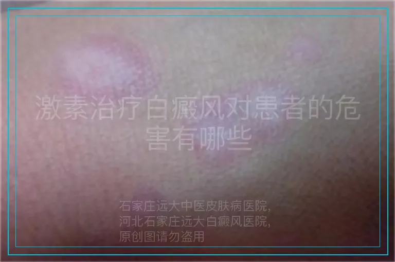 激素治疗白癜风对患者的危害有哪些