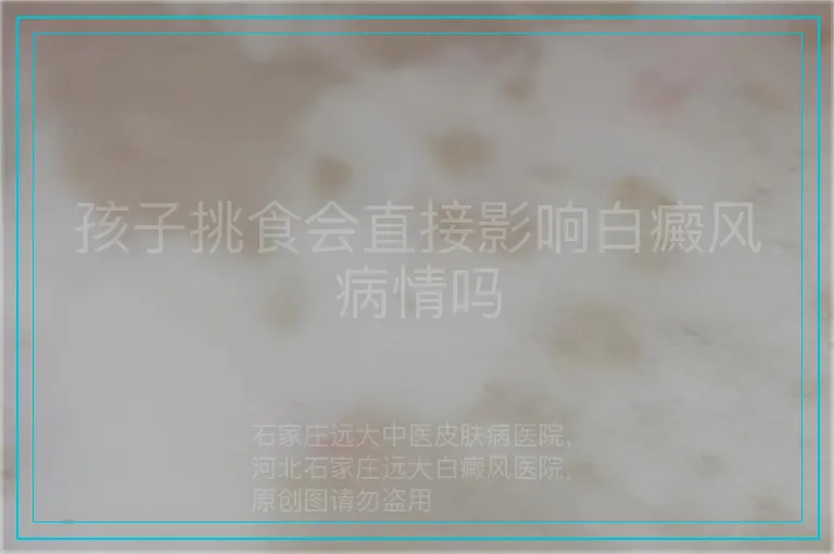 孩子挑食会直接影响白癜风病情吗