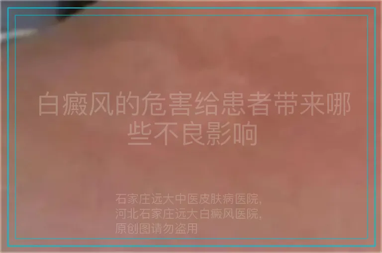 白癜风的危害给患者带来哪些不良影响