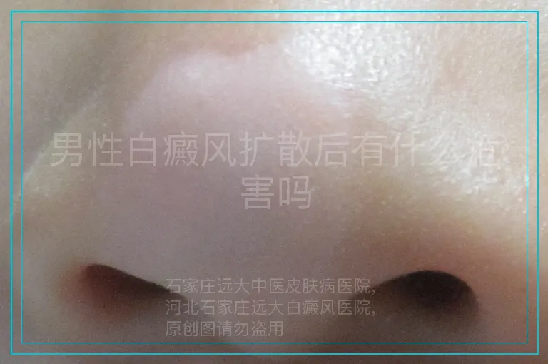 男性白癜风扩散后有什么危害吗