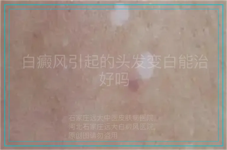 白癜风引起的头发变白能治好吗