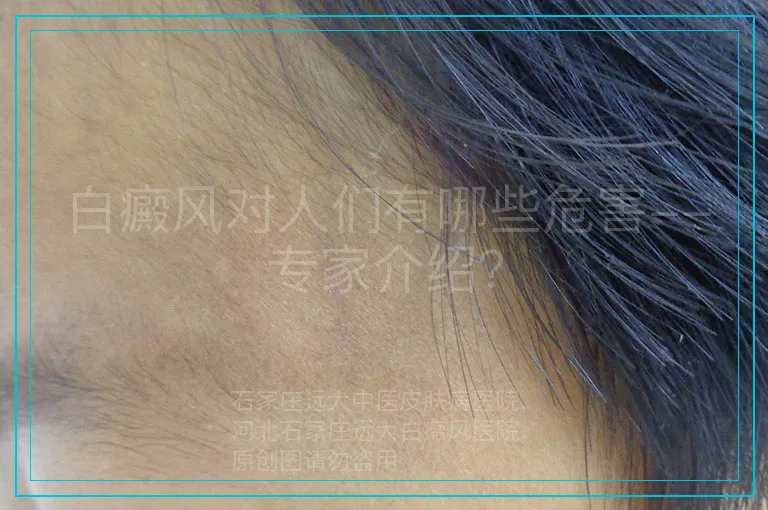 白癜风对人们有哪些危害--专家介绍？