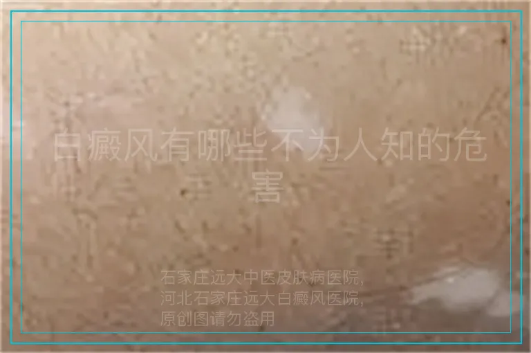 白癜风有哪些不为人知的危害