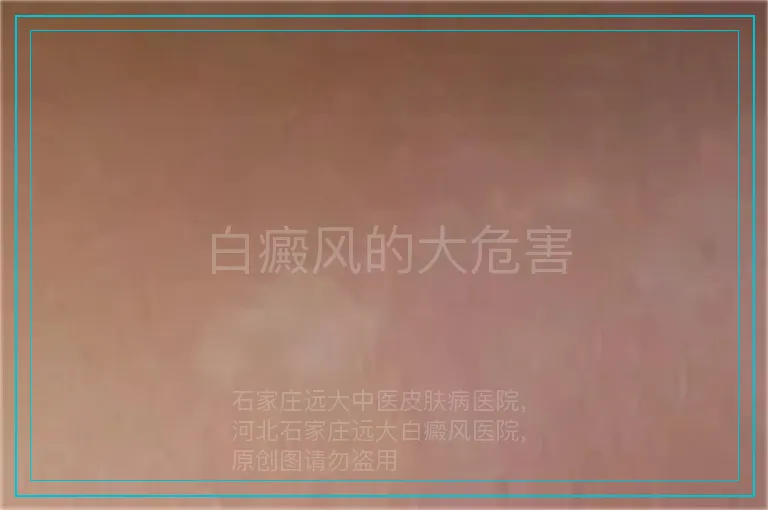 白癜风的大危害
