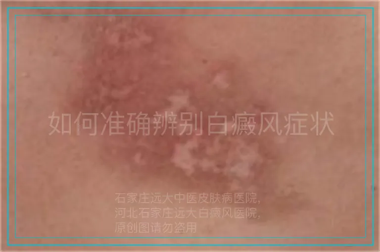 如何准确辨别白癜风症状