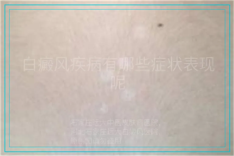 白癜风疾病有哪些症状表现呢