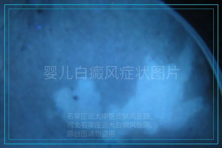 婴儿白癜风症状图片