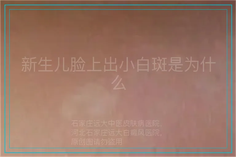 新生儿脸上出小白斑是为什么