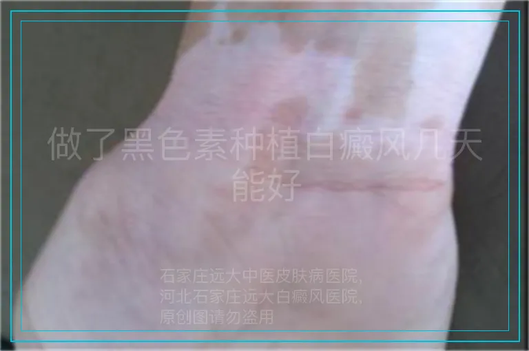 做了黑色素种植白癜风几天能好