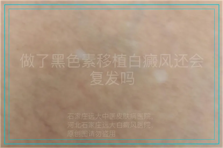 做了黑色素移植白癜风还会复发吗