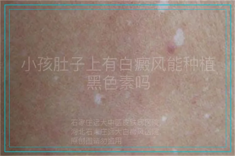 小孩肚子上有白癜风能种植黑色素吗