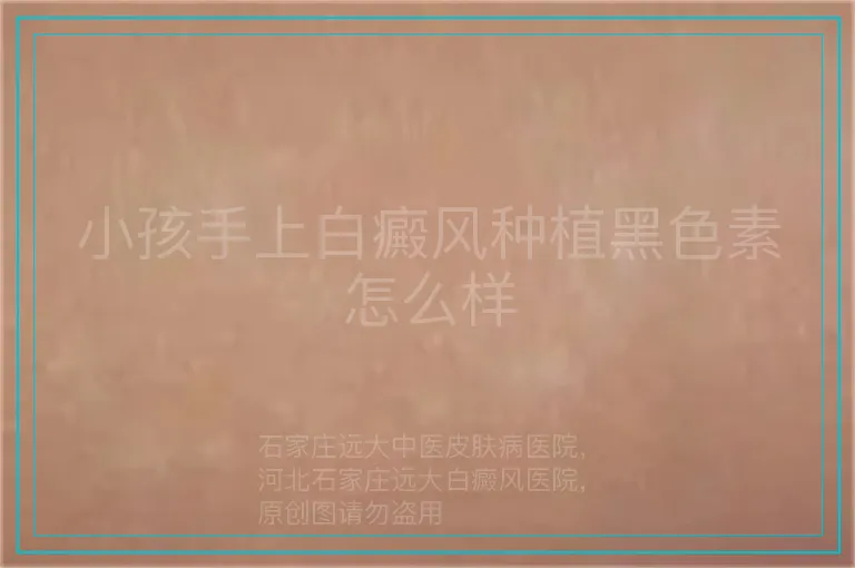 小孩手上白癜风种植黑色素怎么样