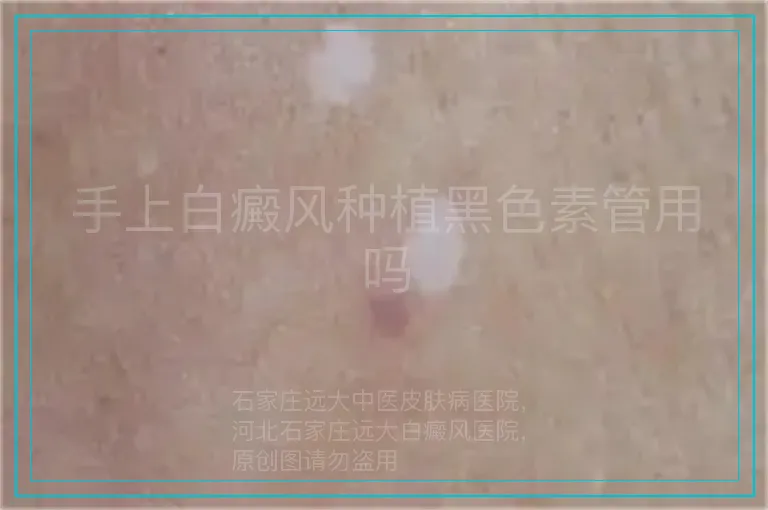 手上白癜风种植黑色素管用吗