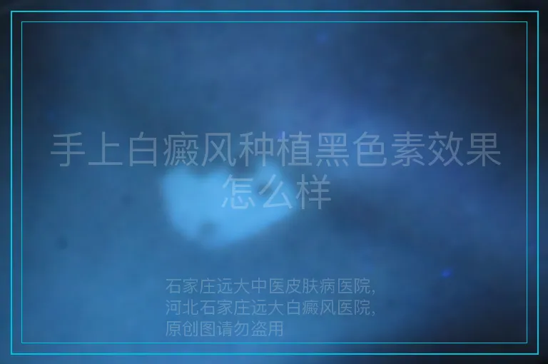 手上白癜风种植黑色素效果怎么样