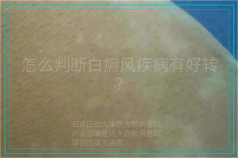 怎么判断白癜风疾病有好转？