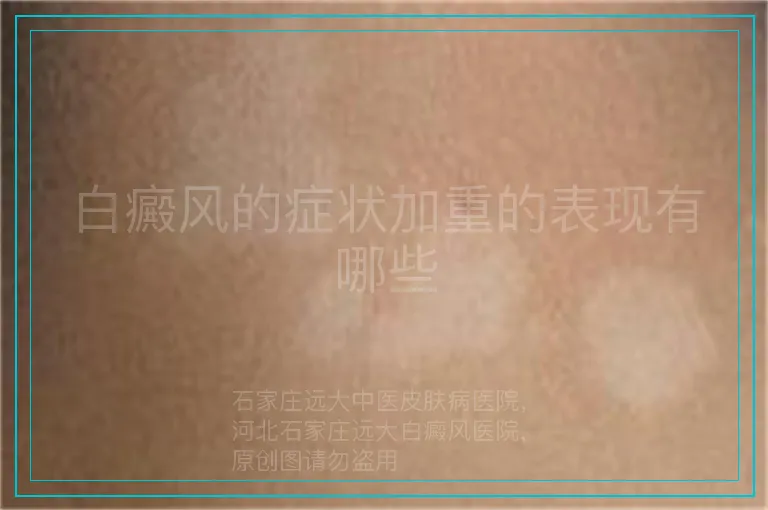 白癜风的症状加重的表现有哪些