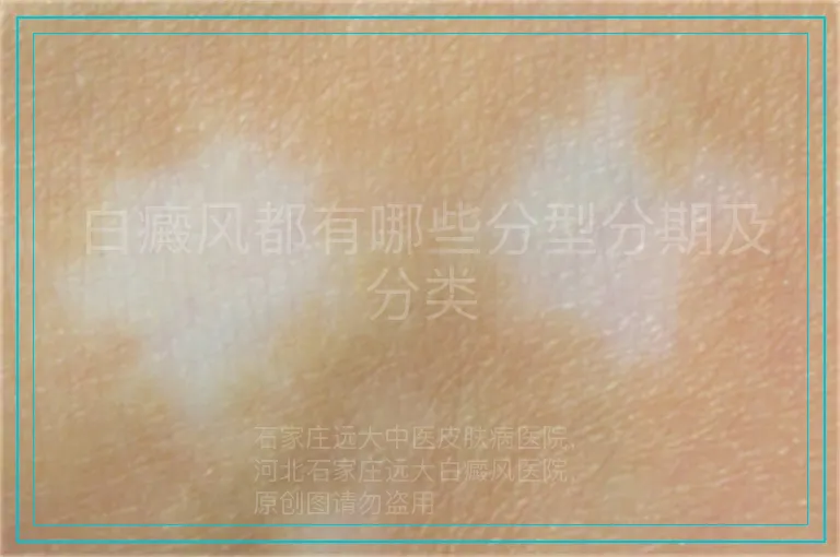 白癜风都有哪些分型分期及分类