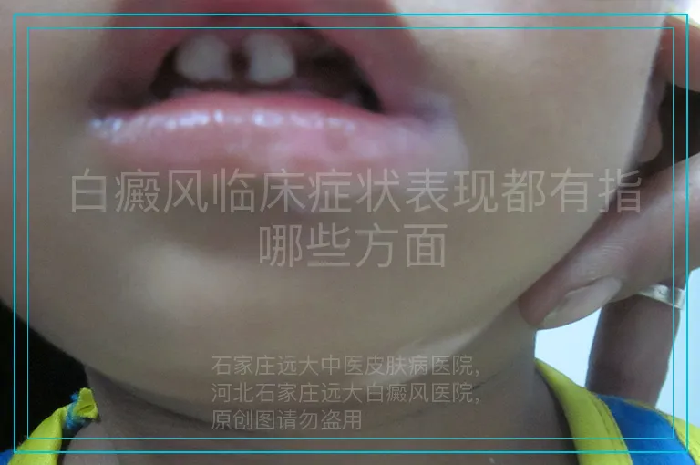 白癜风临床症状表现都有指哪些方面