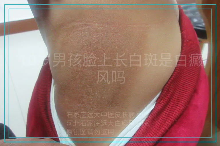 10岁男孩脸上长白斑是白癜风吗