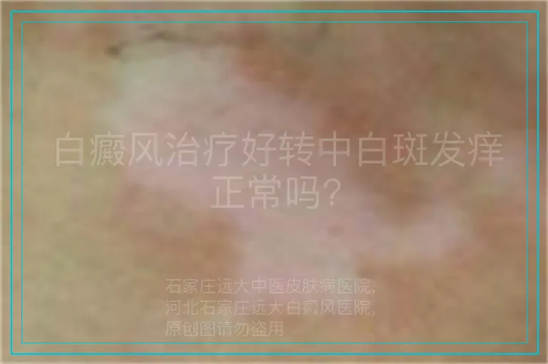白癜风治疗好转中白斑发痒正常吗?