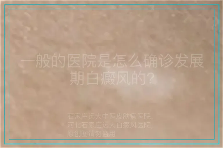 一般的医院是怎么确诊发展期白癜风的?