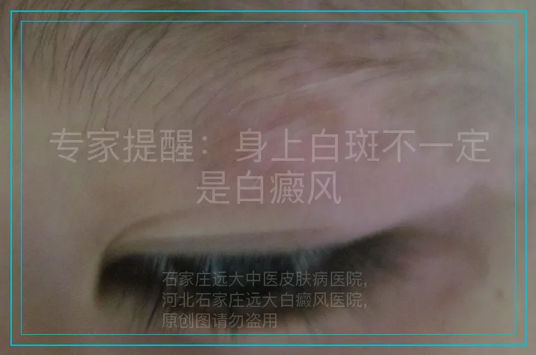 专家提醒：身上白斑不一定是白癜风