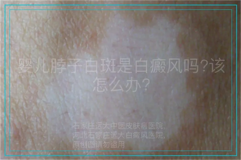 婴儿脖子白斑是白癜风吗?该怎么办?