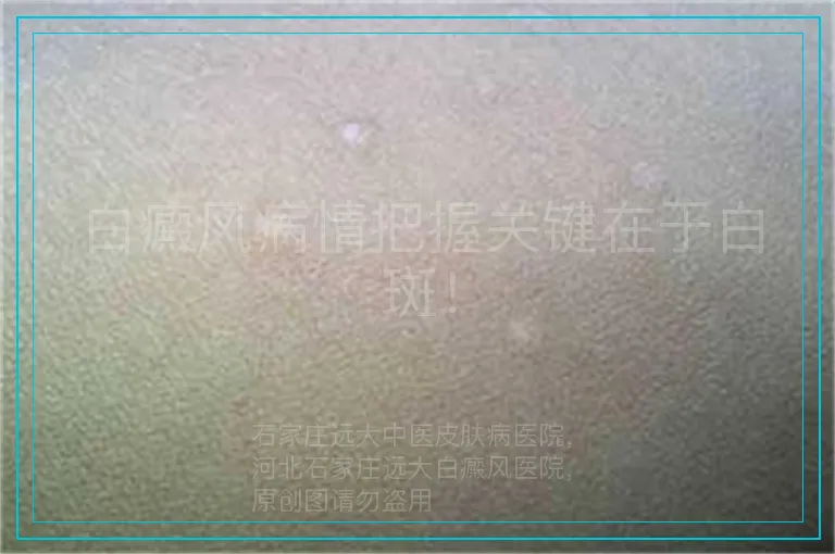 白癜风病情把握关键在于白斑！