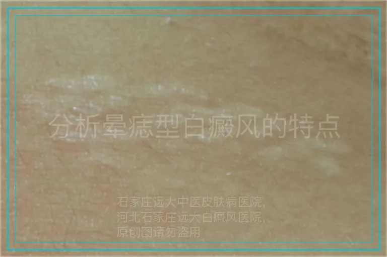 分析晕痣型白癜风的特点