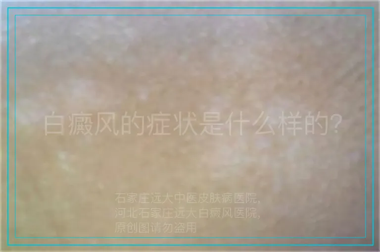 白癜风的症状是什么样的？