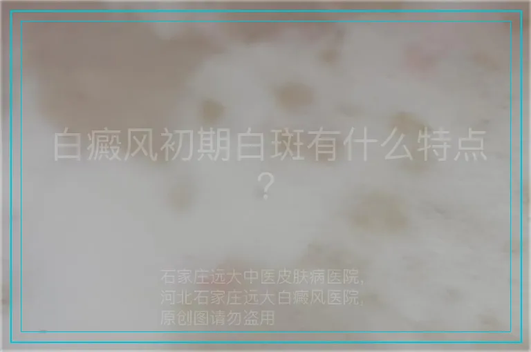 白癜风初期白斑有什么特点？