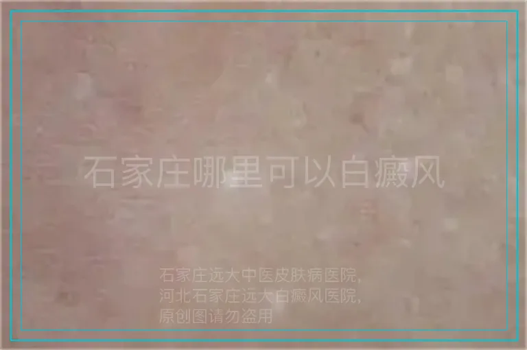 石家庄哪里可以白癜风