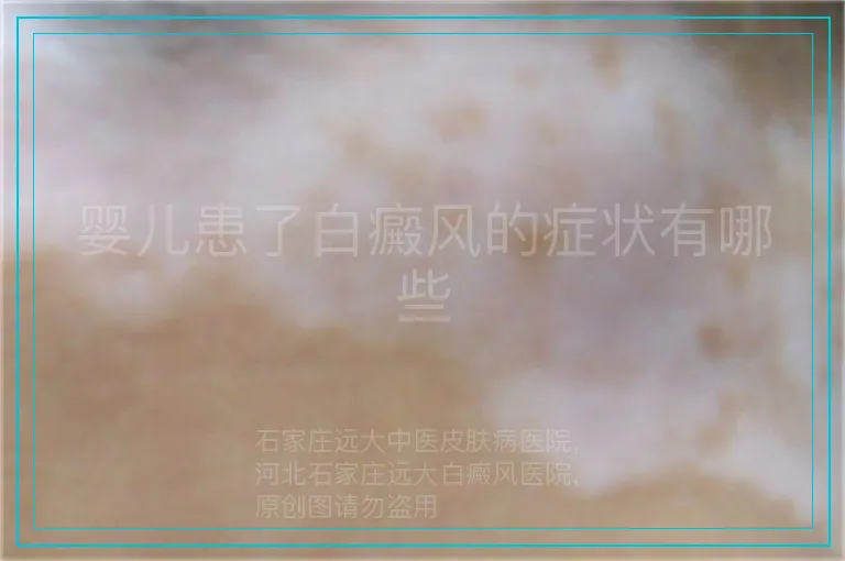 婴儿患了白癜风的症状有哪些