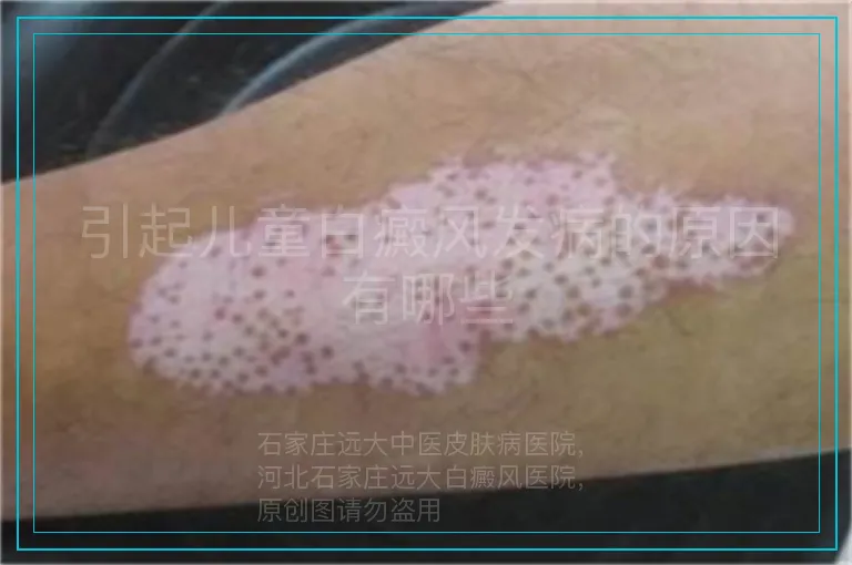 引起儿童白癜风发病的原因有哪些
