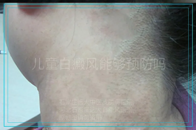 儿童白癜风能够预防吗