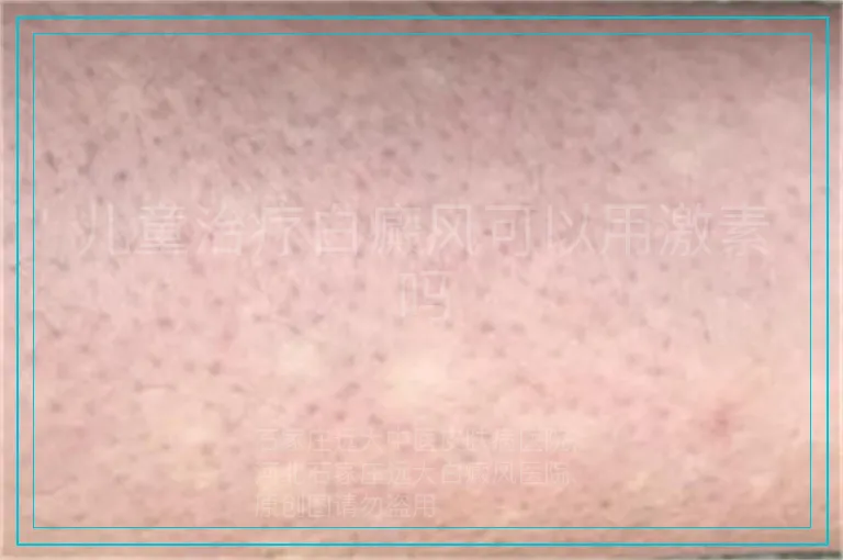 儿童治疗白癜风可以用激素吗