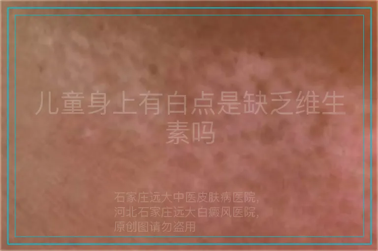 儿童身上有白点是缺乏维生素吗