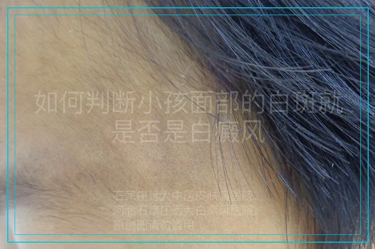 如何判断小孩面部的白斑就是否是白癜风