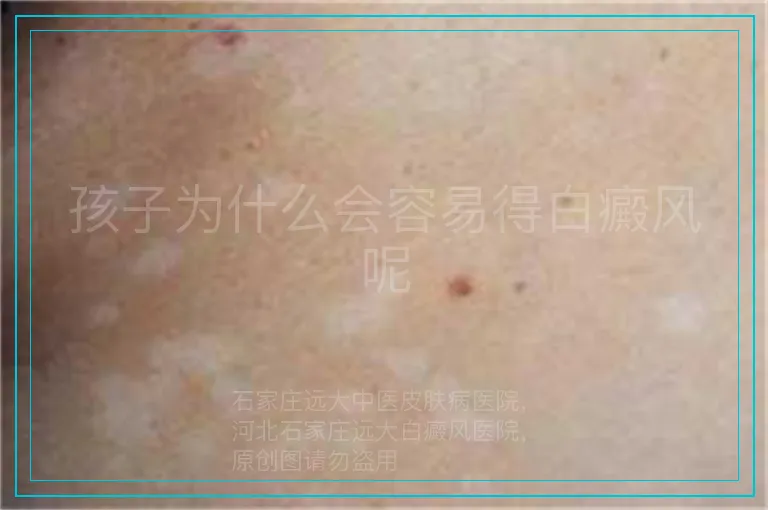 孩子为什么会容易得白癜风呢