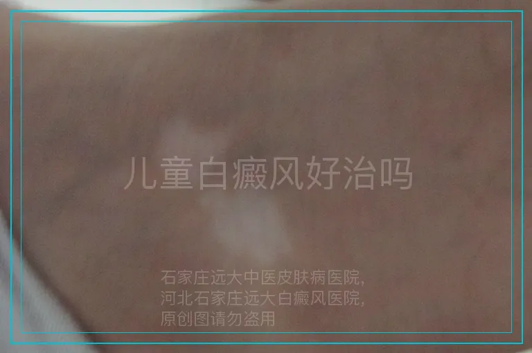儿童白癜风好治吗
