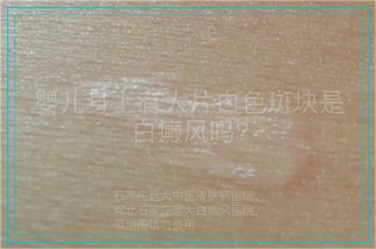 婴儿身上有大片白色斑块是白癜风吗?