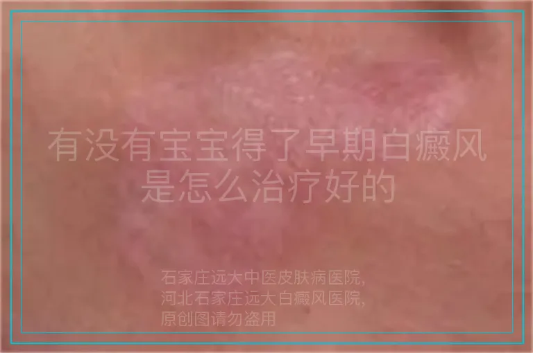 有没有宝宝得了早期白癜风是怎么治疗好的