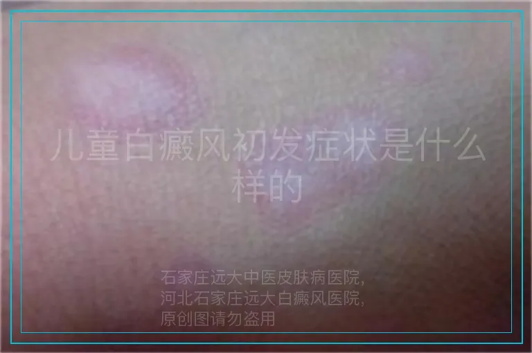 儿童白癜风初发症状是什么样的
