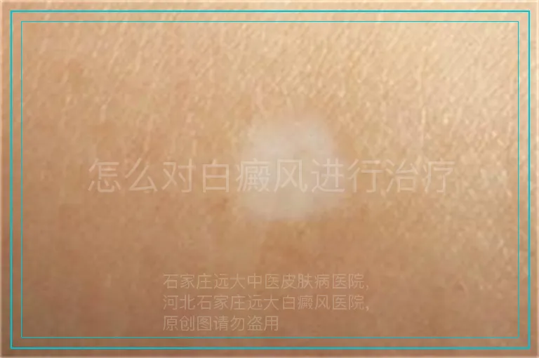 怎么对白癜风进行治疗