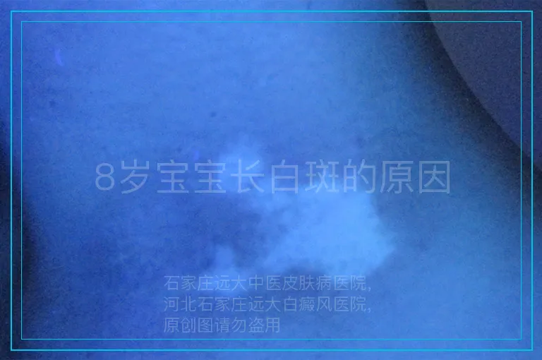 8岁宝宝长白斑的原因
